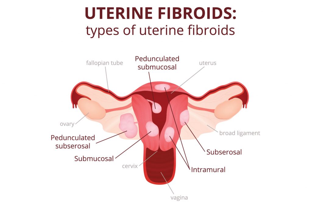 uterine polyps