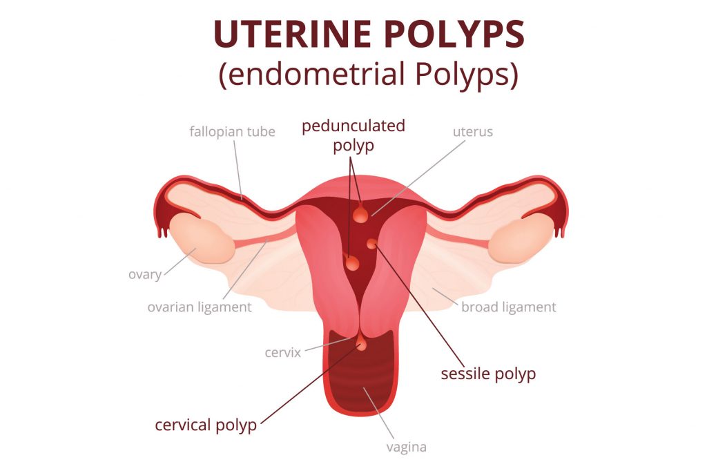 learn-about-fibroids-polyps-pelvic-awareness-project